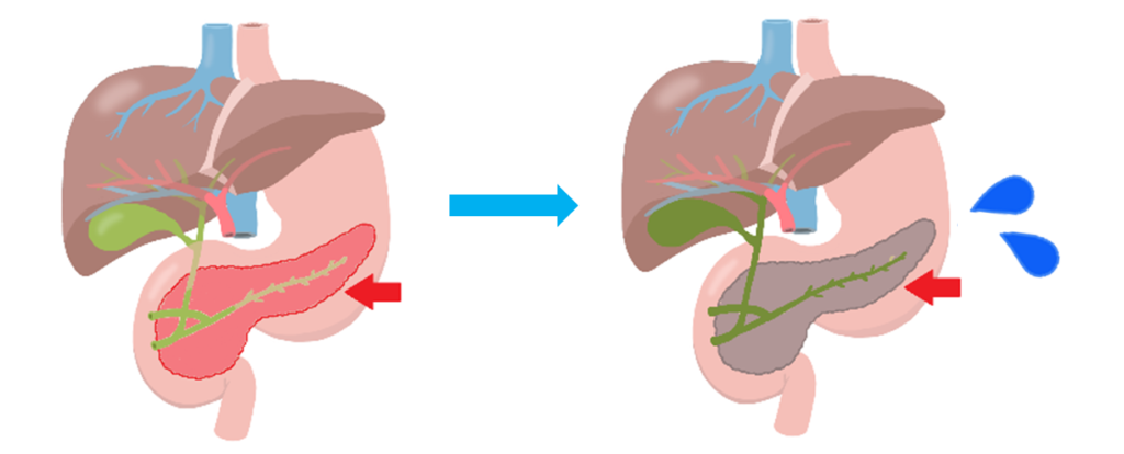 （イラスト）正常なすい臓と弱っているすい臓