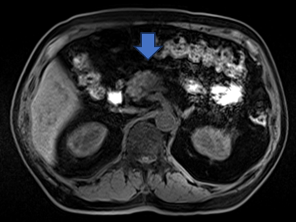 MRI検査にて膵臓癌が確認できます(青矢印)2