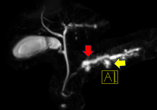 MRCP検査にて膵管の拡張(赤矢印)と膵嚢胞(黄矢印)が確認出来ます
