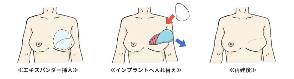 エキスパンダー挿入＞インプラントへ入れ替え＞再建後