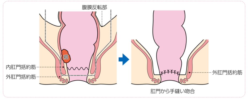 患者さんのための大腸癌治療ガイドライン 2022年版